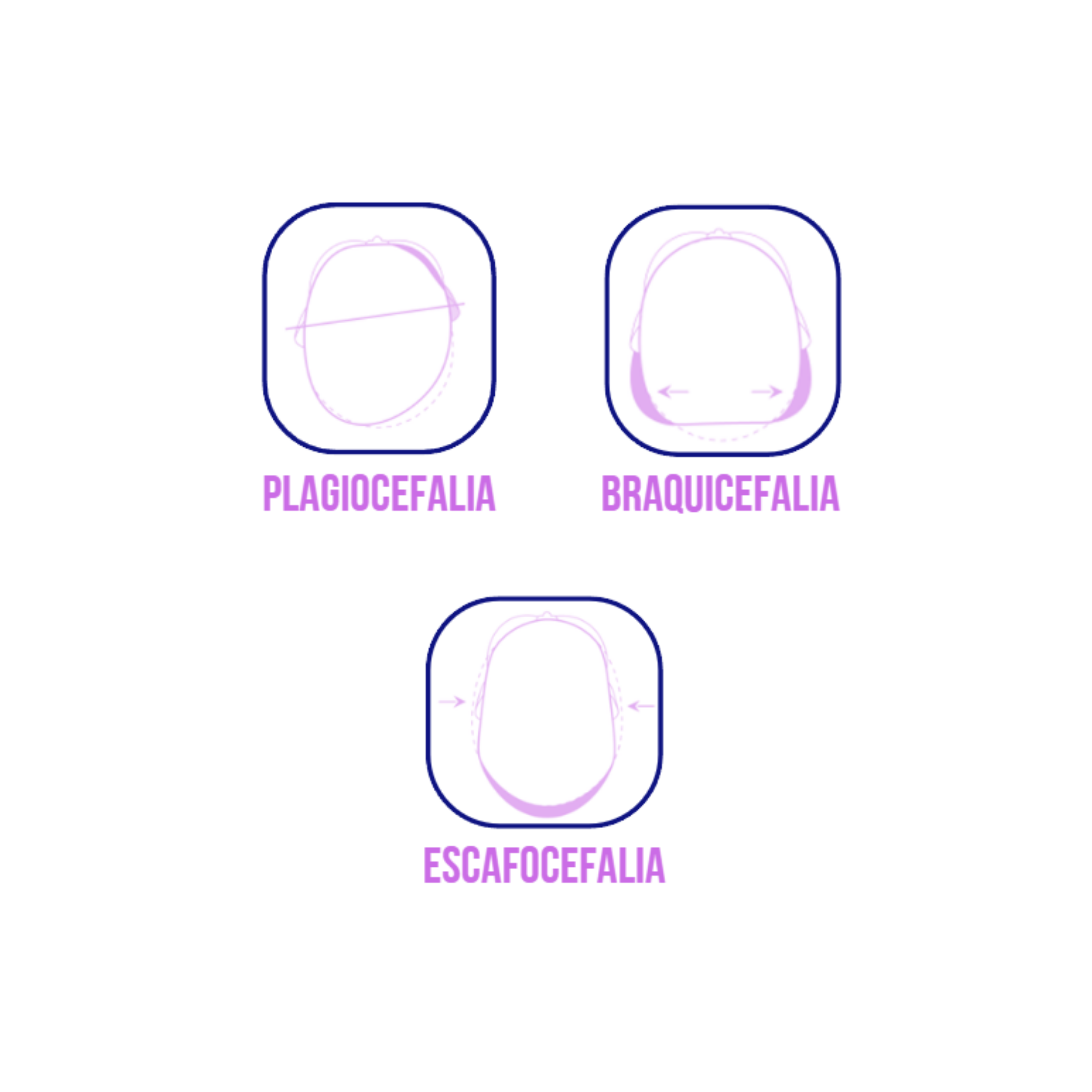 PLAGIOCEFALIA, BRAQUICEFALIA Y ESCAFOCEFALIA